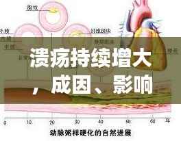 溃疡持续增大,成因、影响及有效治疗策略