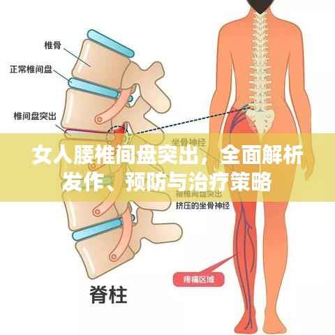 女人腰椎间盘突出,全面解析发作、预防与治疗策略