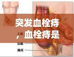 突发血栓痔,血栓痔是急性的吗