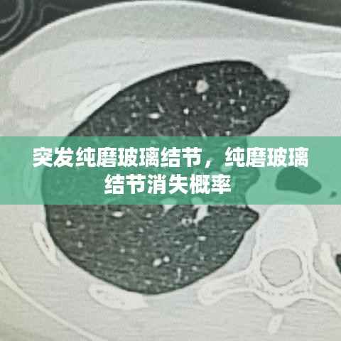 突发纯磨玻璃结节,纯磨玻璃结节消失概率