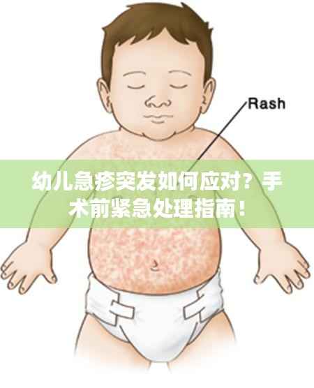 幼儿急疹突发如何应对?手术前紧急处理指南!