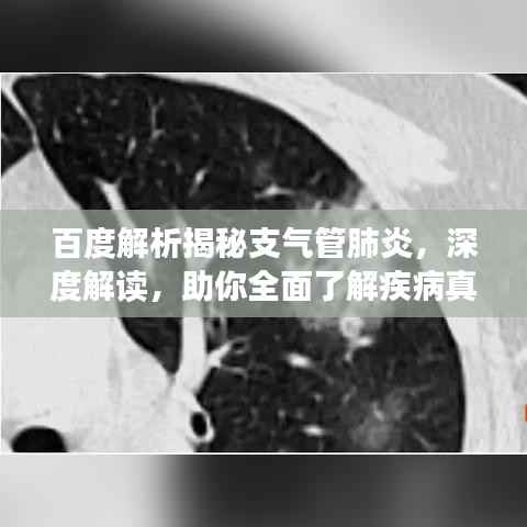 百度解析揭秘支气管肺炎，深度解读，助你全面了解疾病真相！